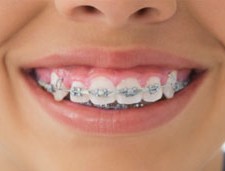 child-braces_377x171